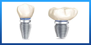 One day dental implants