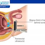 How painful is a biopsy of the prostate?