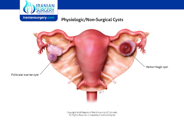 Ruptured Ovarian Cyst