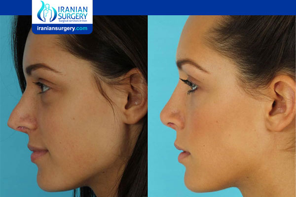 Revision Rhinoplasty Swelling