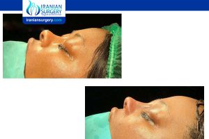 revision rhinoplasty in iran before and after