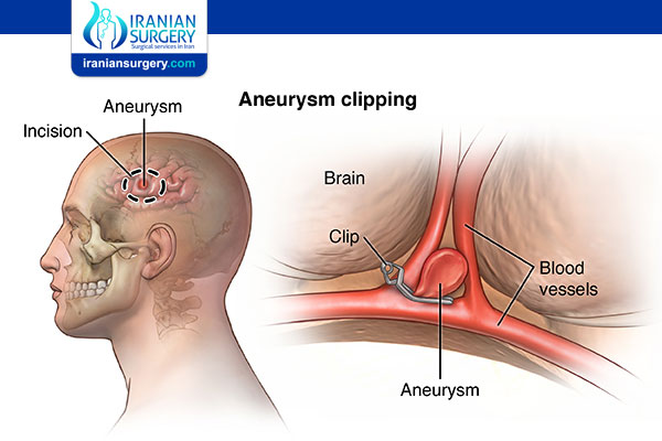 Are Brain Aneurysms Painful?