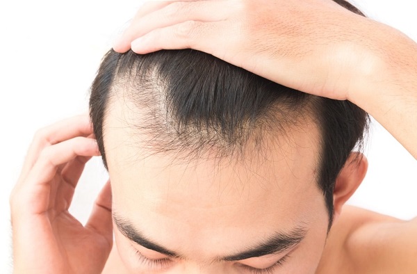 هل انتفاخ الجبهة بعد عملية زراعة الشعر طبيعي؟