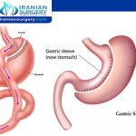 Gastric bypass vs duodenal switch
