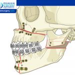 Double Jaw Surgery (Bimaxillary Osteotomy)