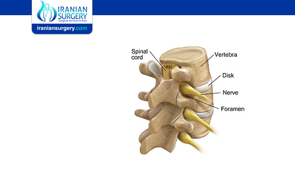 Foraminotomy | Iranian Surgery