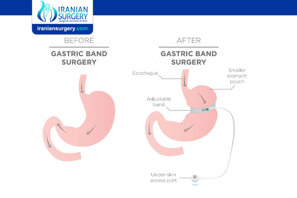 Gastric banding surgery pros and cons
