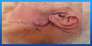 Mastoidectomy Scar