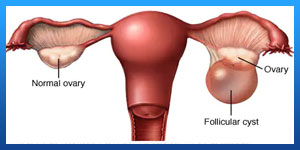 Ruptured Ovarian Cyst