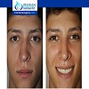 how long does swelling last after septoplasty