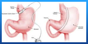 Gastric banding surgery pros and cons