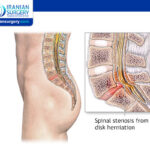 Spinal Stenosis