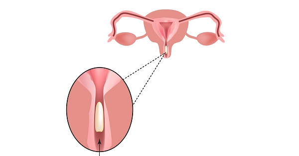 ما هي أنواع مثبت الحمل بعد التلقيح الصناعي؟