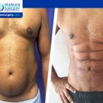 Six-pack liposuction