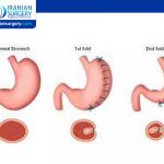 Gastric Band vs Gastric Sleeve