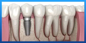 dental implants in iran