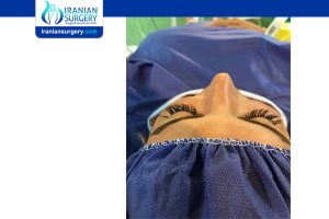 revision rhinoplasty in iran