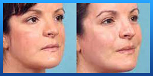 cheek implat before andafter 