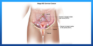 سرطان الرحم