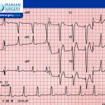 Wolff-Parkinson-White (WPW) Syndrome