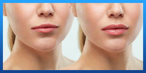 lip augmentation 