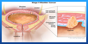 سرطان المثانة عند الرجال