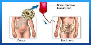 Bone Marrow Transplant in Iran