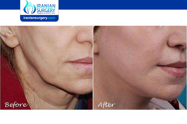 The Anatomy of a High-Risk Extraction