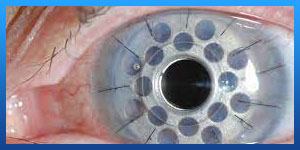 Cornea transplant in Iran