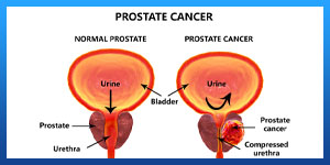 orchiectomy for prostate cancer