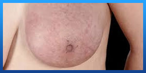 early stage breast cancer treatment
