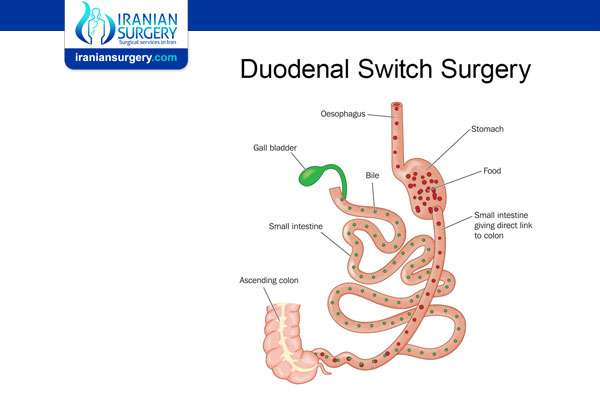 Duodenal Switch Revision