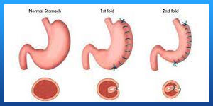Gastric sleeve plication complications