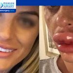 Allergic Reaction to Lip Filler Treatment