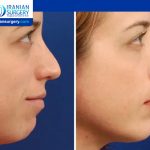 Chin Implant Risks