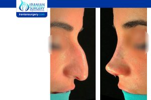 rhinoplasty in iran before and after