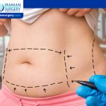 Fat Redistribution After Liposuction