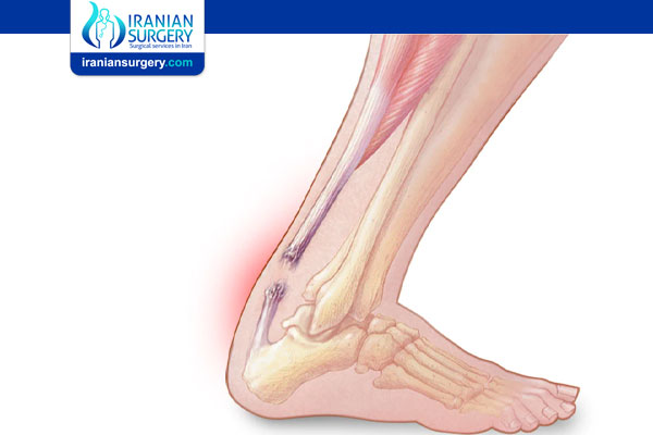 Achilles tendon Rupture
