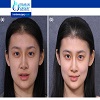 Nose Implant Removal