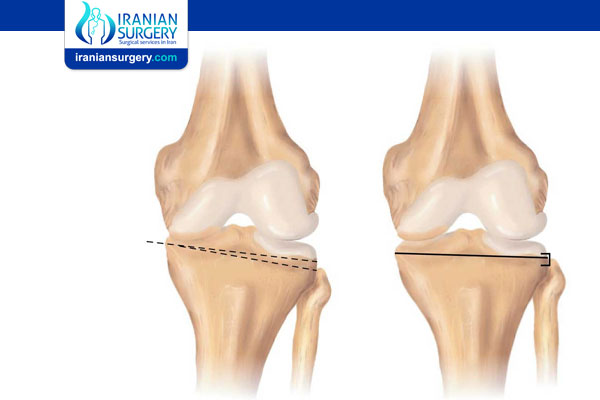 Knee Osteotomy