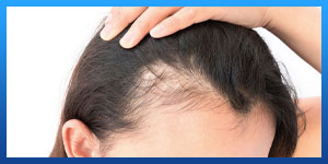 علاج تساقط الشعر الشديد عند النساء