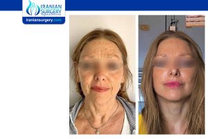 facial plastic surgery