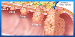 مراحل سرطان القولون