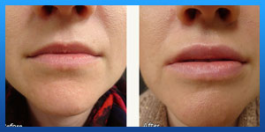 lip augmentation 