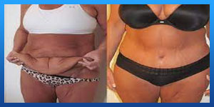 plastic surgery after bariatric surgery