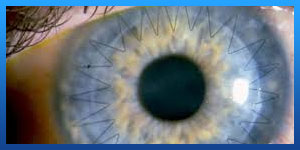 Cornea transplant in Iran