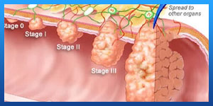 symptoms of colon cancer in females