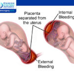 Placental Abruption