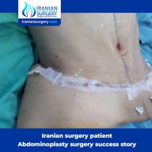 swelling after liposuction abdomen