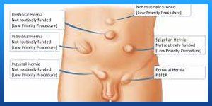 Femoral Hernia vs Inguinal Hernia